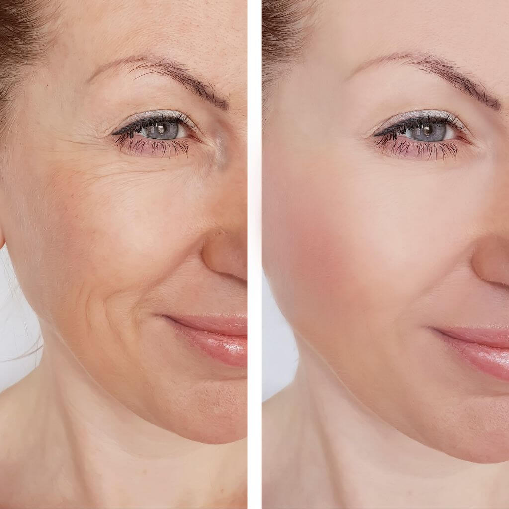 Descubre cómo el rejuvenecimiento facial puede revelar la belleza de una piel radiante en nuestro artículo